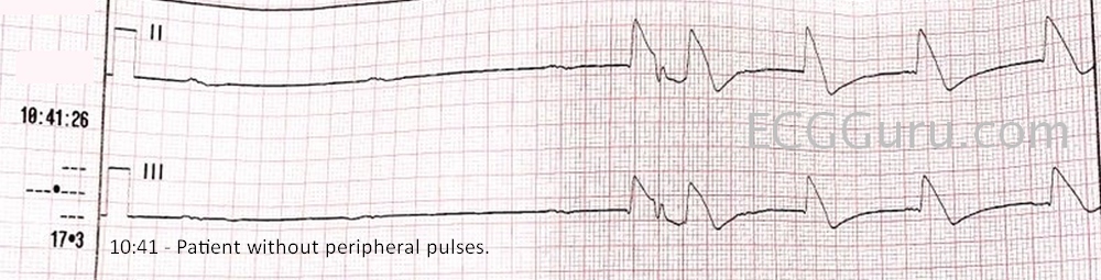Shark Fin Pattern ECG Guru Instructor Resources shark-fin-pattern-ecg-guru-instructor-resources